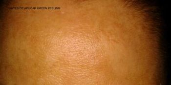 1ª APLICACIÓN DE GREEN PEELING